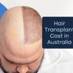 How Much Does a Hair Transplant Cost in Australia?