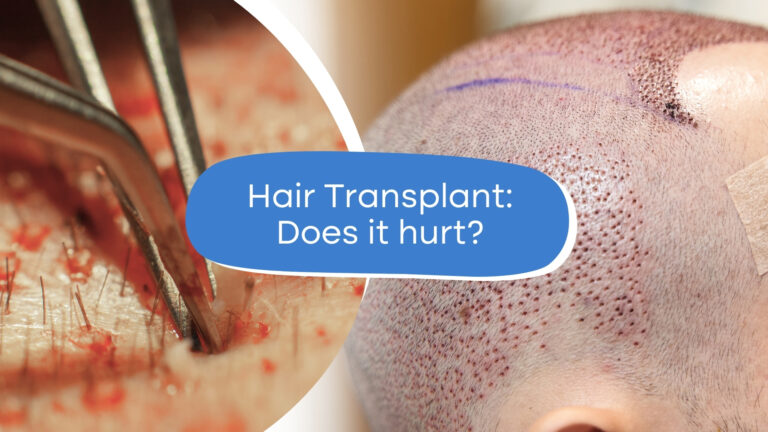 Does Hair Transplant Surgery Hurt? Our Experts Explain