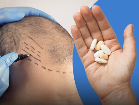 Hair Transplant vs Dutasteride