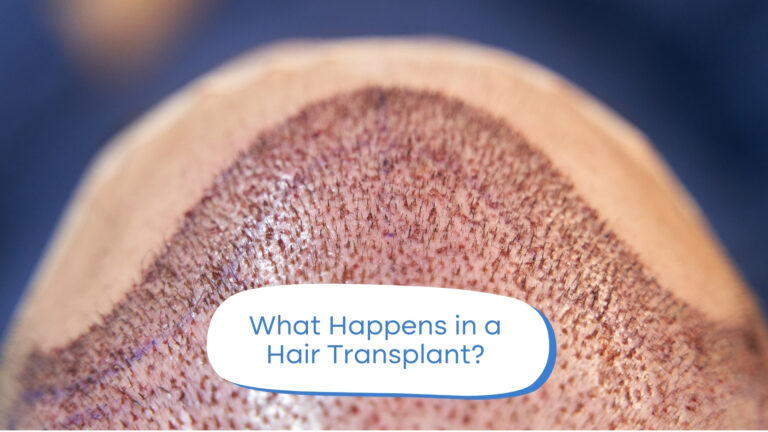 How Does Hair Transplant Surgery Work?