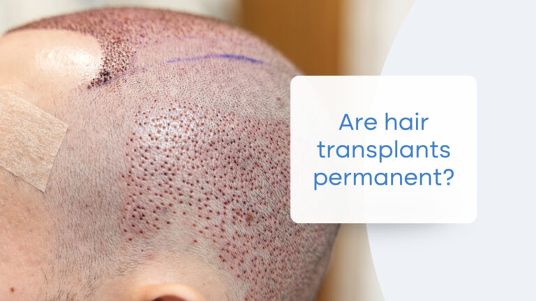 Is Hair Transplant Surgery Permanent? Your Guide