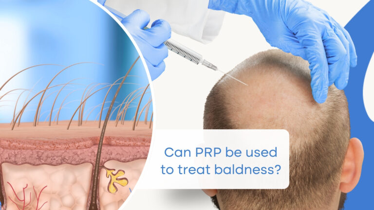 Is There a PRP Treatment for Baldness?