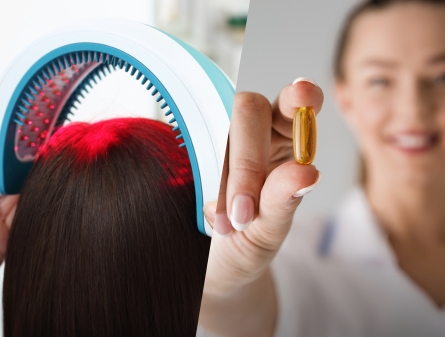 Laser Therapy vs Finasteride
