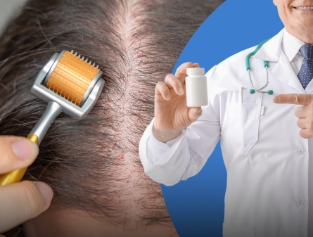 Microneedling vs Finasteride