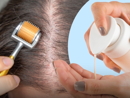 Microneedling vs Hair Loss Shampoo