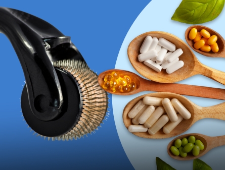 Microneedling vs Hair Vitamins