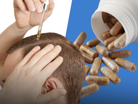 Minoxidil vs Dutasteride