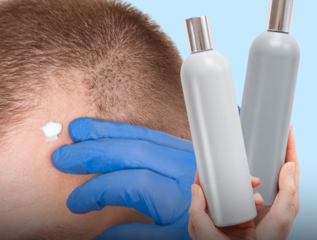 Minoxidil vs Hair Loss Shampoo