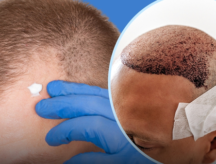 Minoxidil vs Hair Transplant