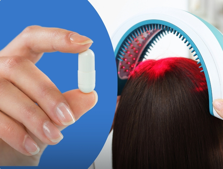Minoxidil vs Laser Therapy