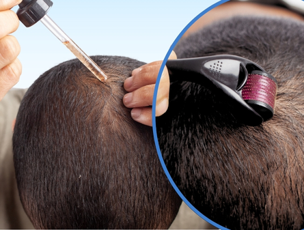 Minoxidil vs Microneedling