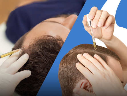 PRP vs Minoxidil